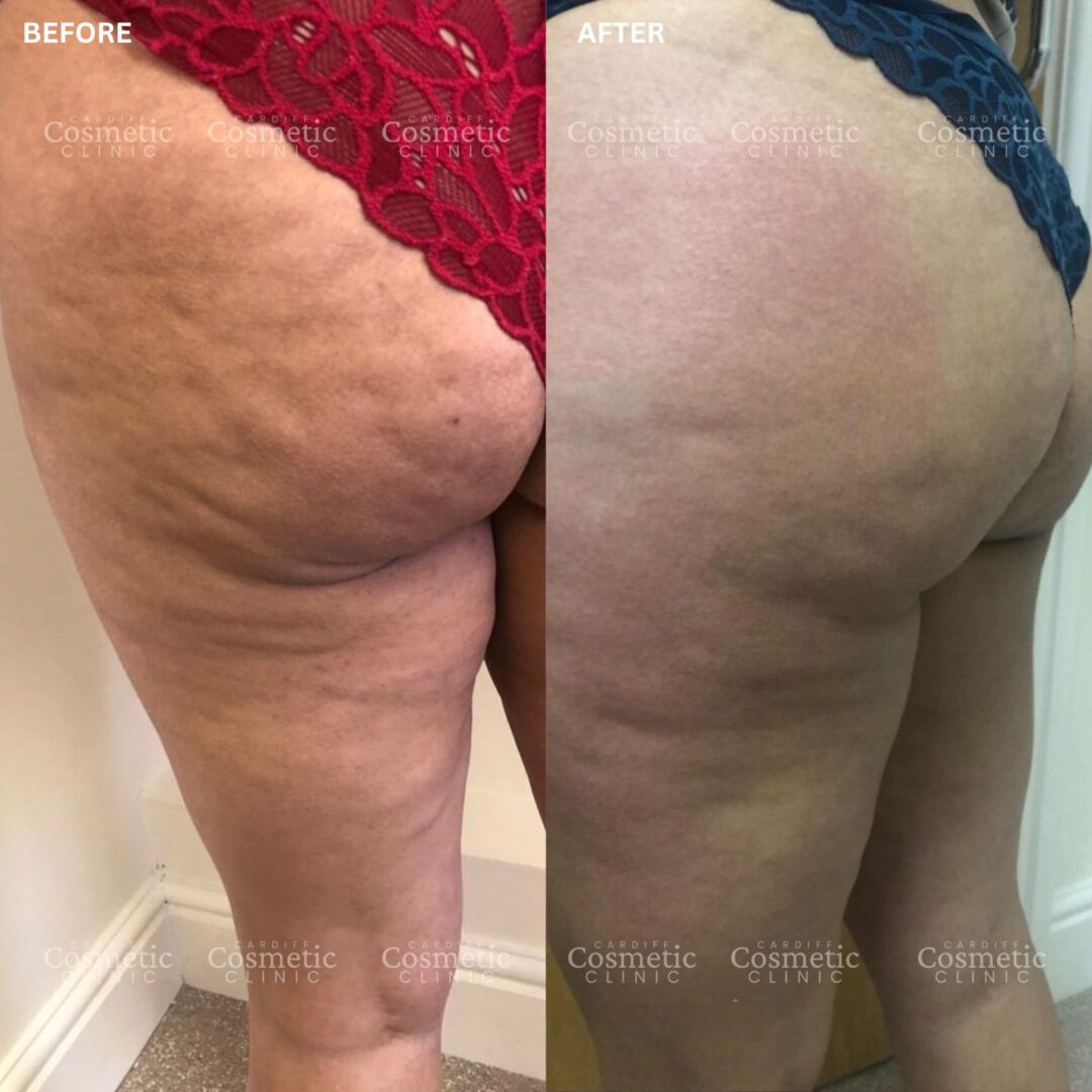 Cellulite removal Cardiff