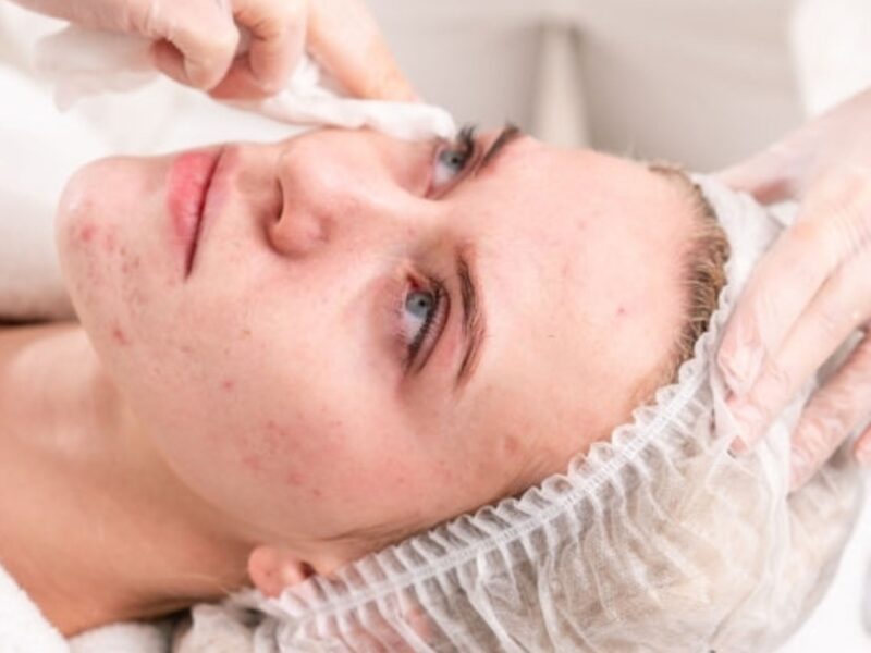 Acne & acne scar treatment