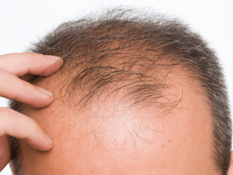 hair loss condition